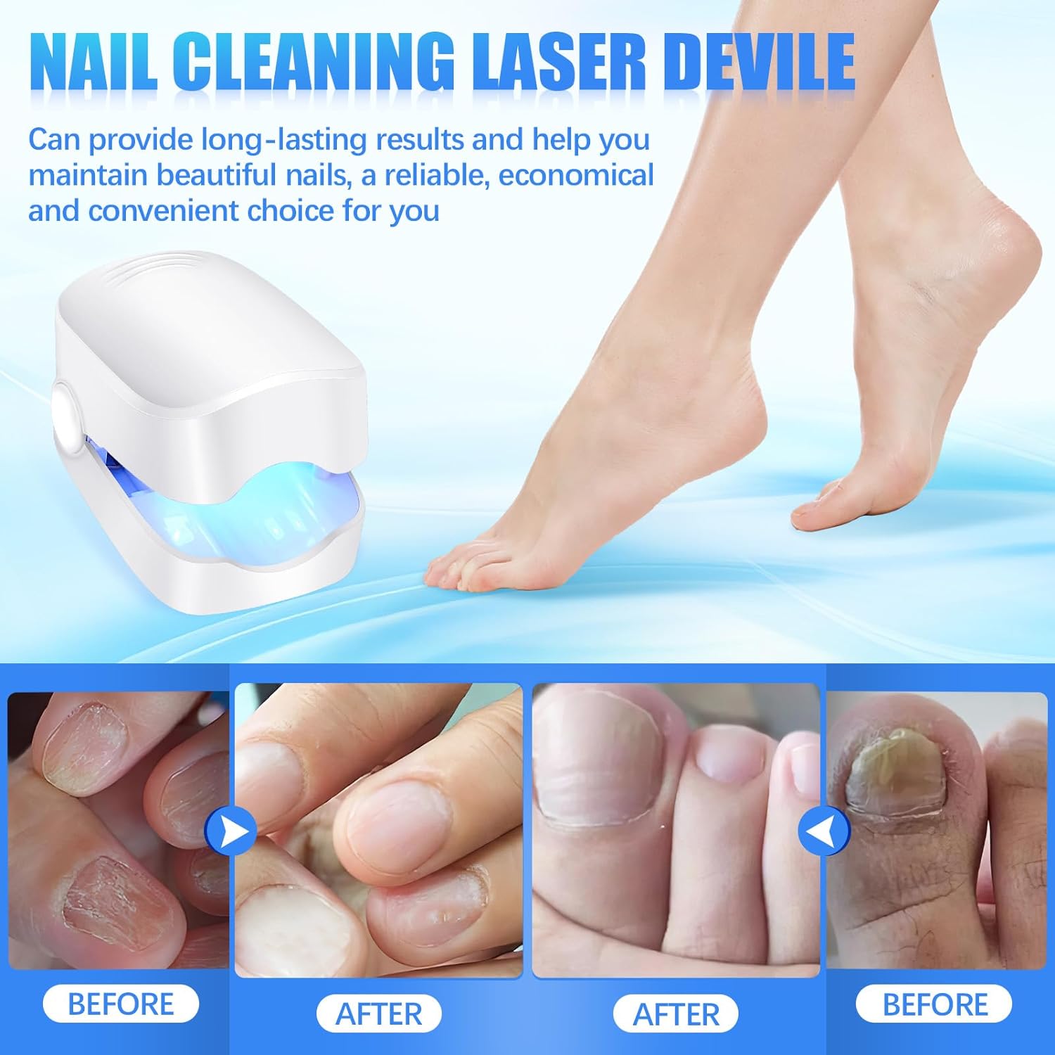 Rechargeable Nail Fungus Treatment for Toenail, Toe Nail Fungal Treatment Nail Fungus Laser Device, Anti-Fungal Nail Treatment for Hand & Feet Infections Remover for Home Use - Shopmania Wholesale